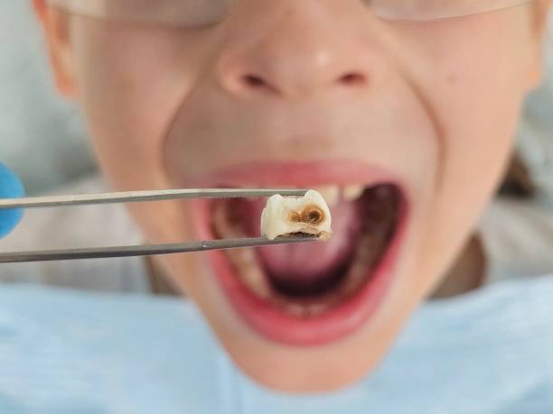 Best Emergency Dentist for Lost Fillings or Crowns in Saybrook On The Lake, OH